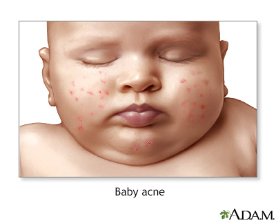 Acne dating website